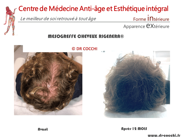 Résultats mésogreffe de cheveux Rigenera à 12 mois
