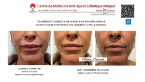 La hyaluronidase une enzyme qui permet de corriger une injection d'acide hyaluronique ratée La hyaluronidase une enzyme qui permet de corriger une injection d'acide hyaluronique ratée