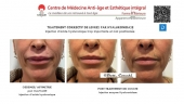 La hyaluronidase une enzyme qui permet de corriger une injection d'acide hyaluronique ratée