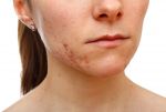 Cicatrices d’acné : l’association miracle du microneedling et du peeling PXR33