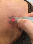 Eliminer les tatouages grâce au laser Q-Switched