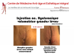 L’augmentation du volume des grandes lèvres par injections d’acide hyaluronique