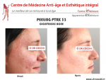 Le peeling PTRX 33 + needling pour traiter les cicatrices d’acné