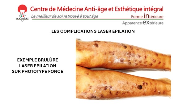 Exemple de brûlure sur phototype foncé après une épilation laser