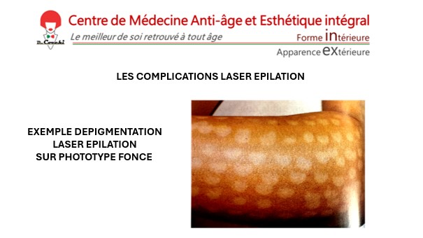 Exemple de dépigmentation sur phototype foncé après une épilation laser