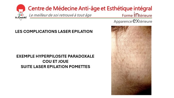 Exemple d'hyperpilosité paradoxale sur le cou et les joue suite à une épilation laser des pommettes