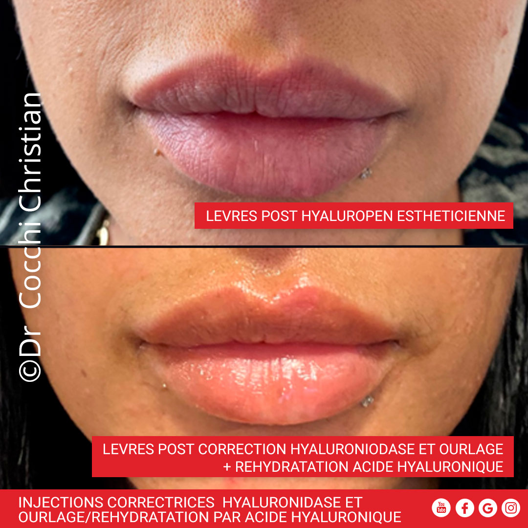 Injections correctrices hyaluronidase et ourlage/r&eacute;hydratation par acide hyaluronique