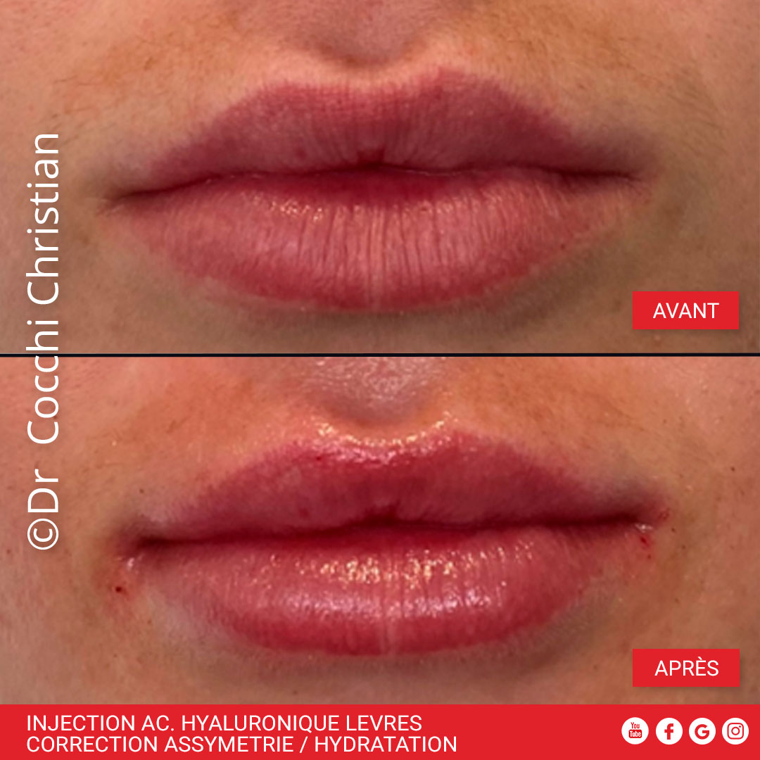 Injection acide hyaluronique l&egrave;vres : correction asym&eacute;trie et hydratation
