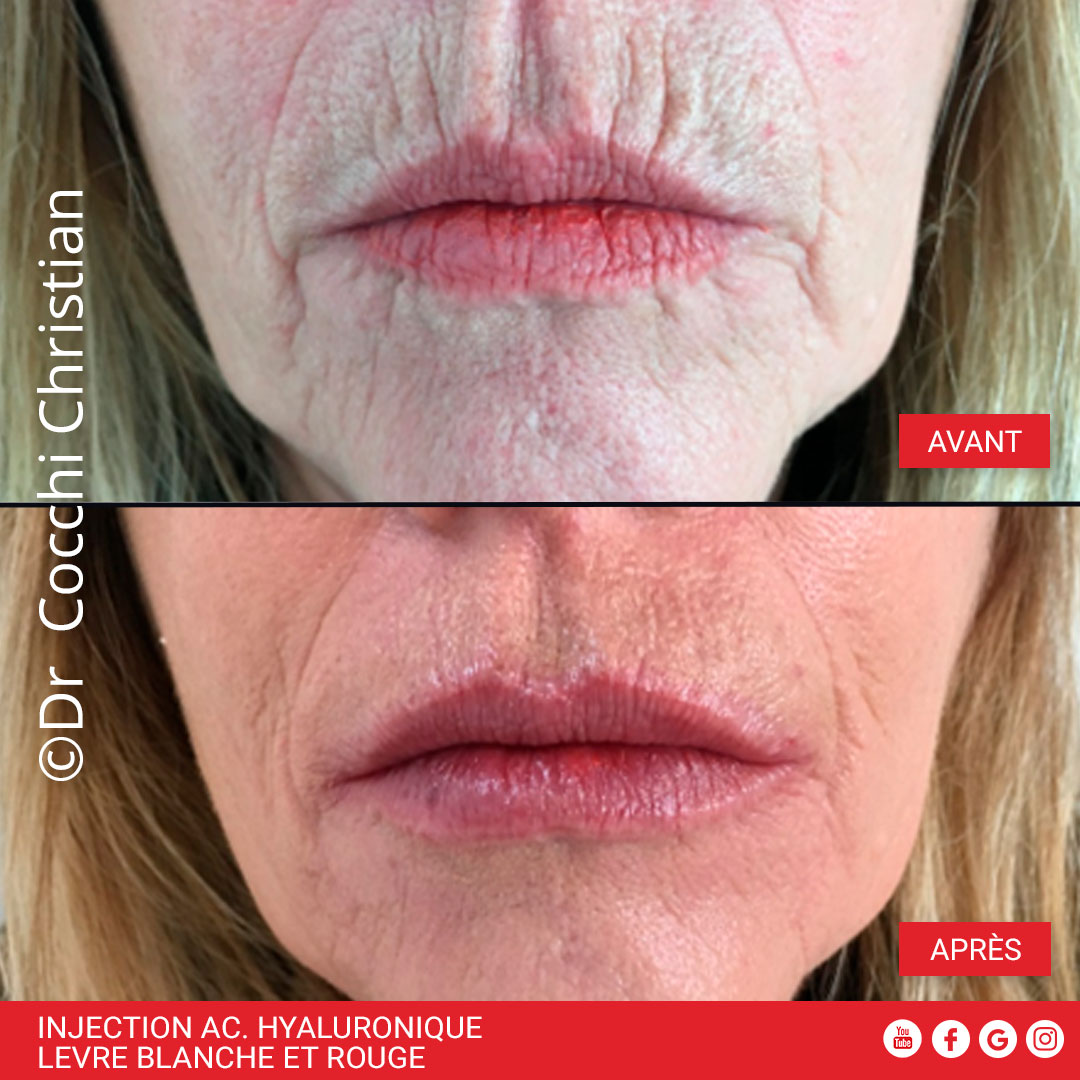 Injection acide hyaluronique de la l&egrave;vre blanche et rouge