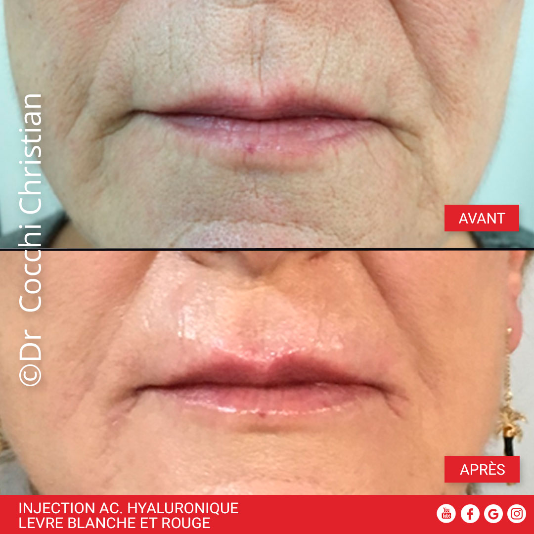 Injection acide hyaluronique correction l&egrave;vre blanche et rouge
