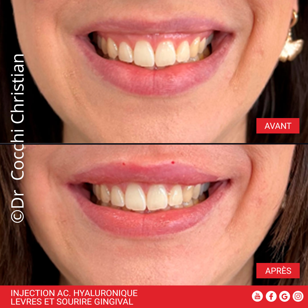 Injection d'acide hyaluronique pour corriger un sourire gingival
