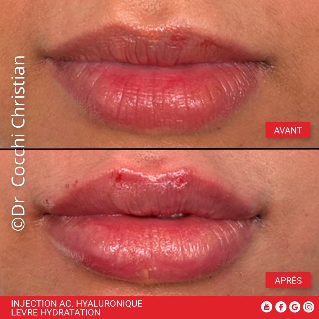 Hydratation des l&egrave;vres par injection d'acide hyaluronique