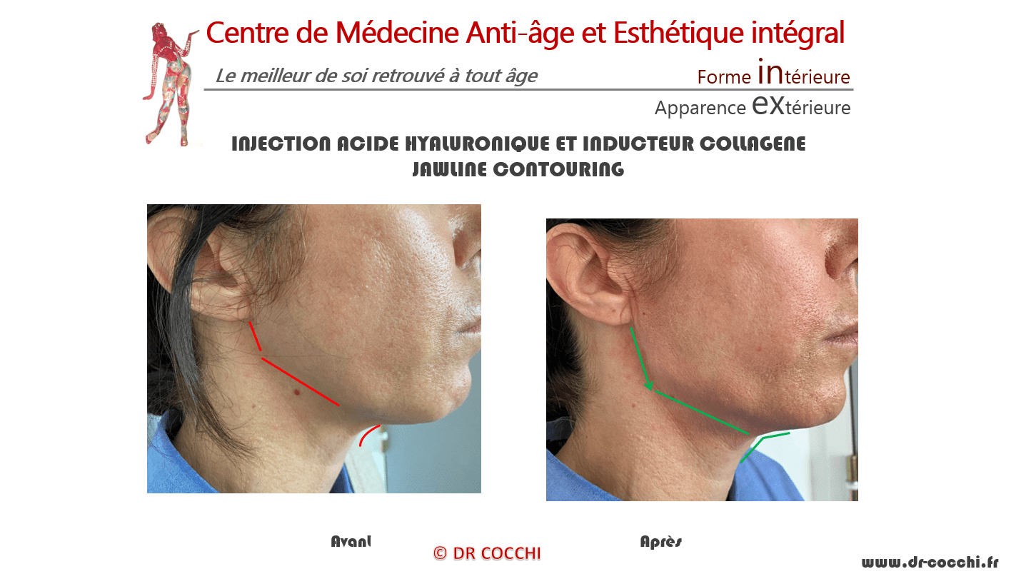 Jawline Exerciseur Double Réducteur De Menton Tonification - Temu France