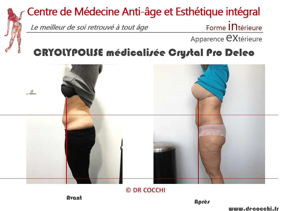 Cryolipolyse à La-Teste-de-Buch pour réduire bourrelets abdomen