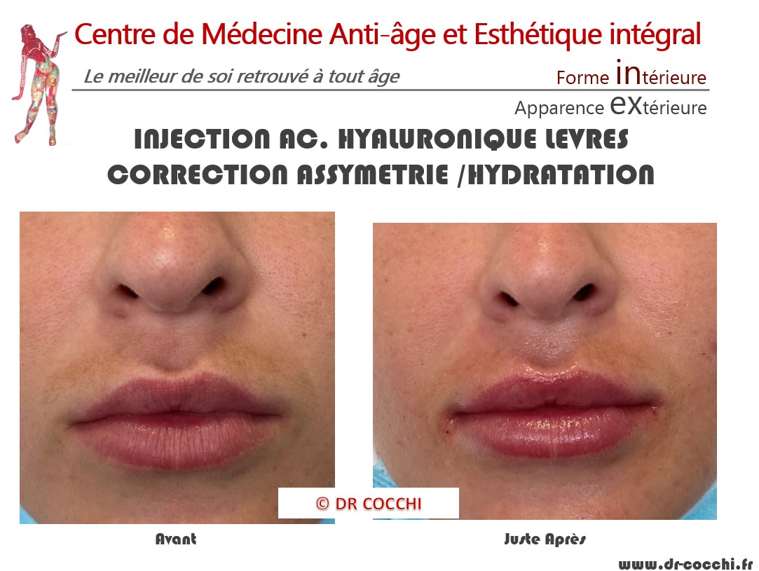 Injection Acide Hyaluronique Bordeaux : Hydrater et Redessiner Lèvres