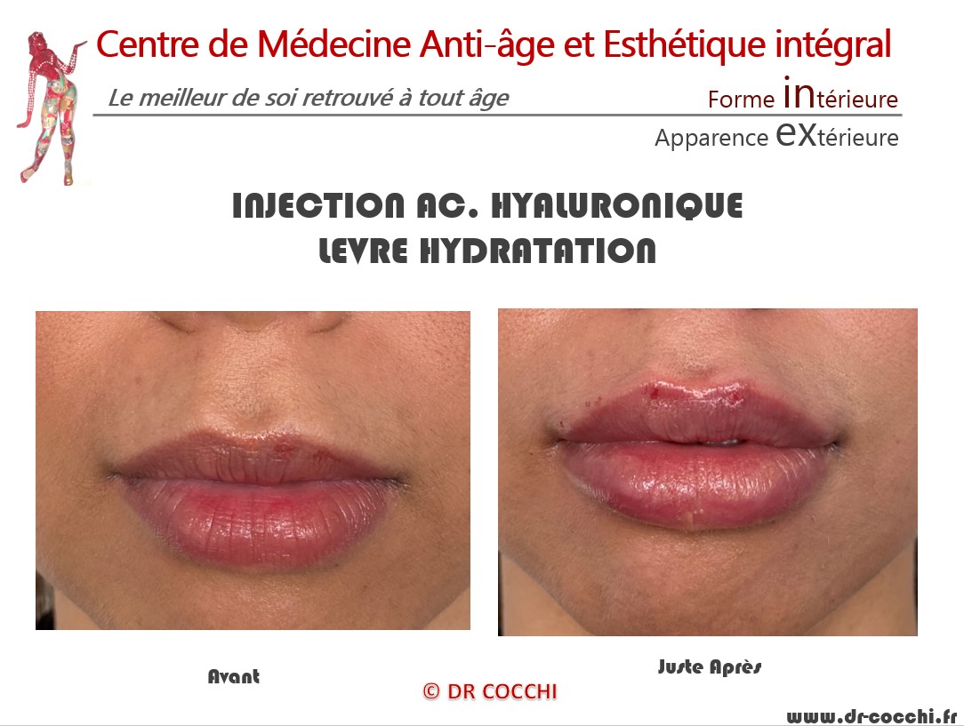 Injection Acide Hyaluronique Bordeaux : Hydrater et Redessiner Lèvres