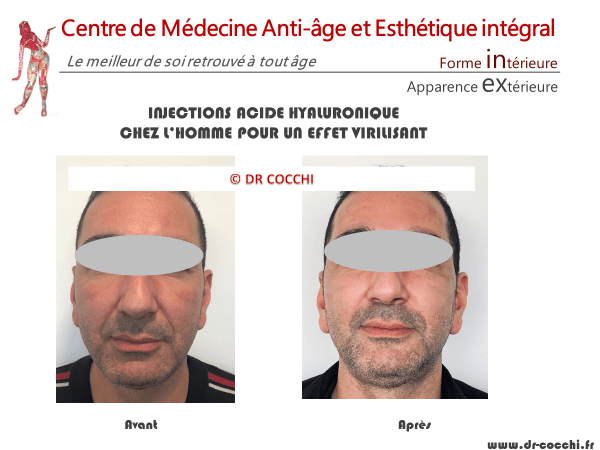 Injections acide hyaluronique homme