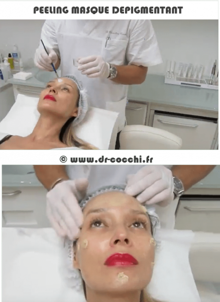 Peeling dépigmentant