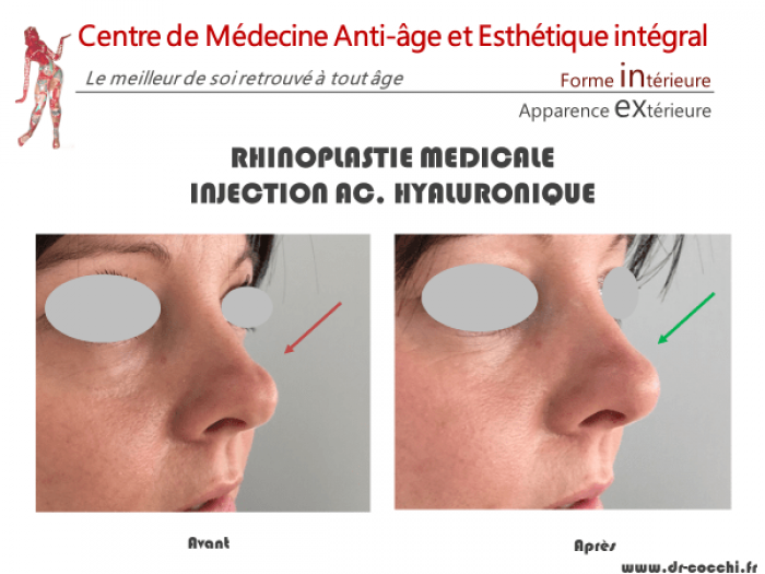 Corriger le nez avec les injections d'acide hyaluronique