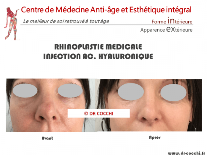 La « rhinoplastie médicale »