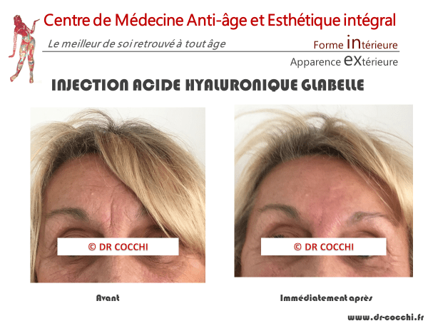 Injection acide hyaluronique glabelle