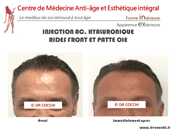 Injection acide hyaluronique rides du front et pattes d'oie
