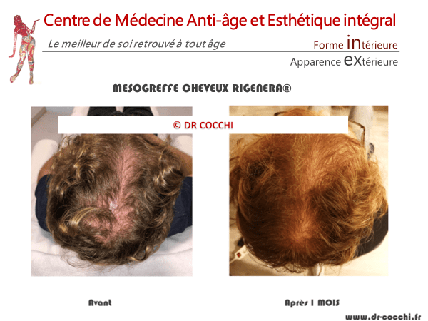 Résultats mésogreffe de cheveux Rigenera à 1 mois