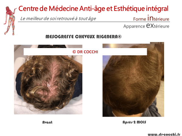 Résultats mésogreffe de cheveux Rigenera à 2 mois