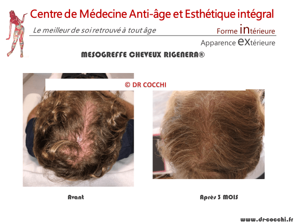 Mésogreffe de cheveux Rigenera®. Micro greffes cuir chevelu ...