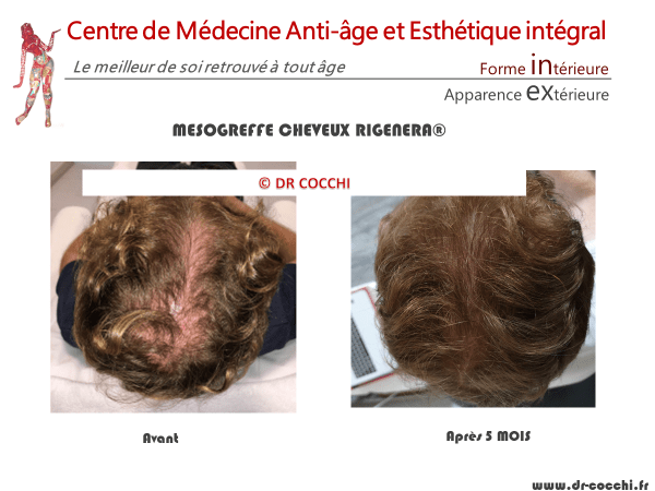 Résultats mésogreffe de cheveux à 5 mois